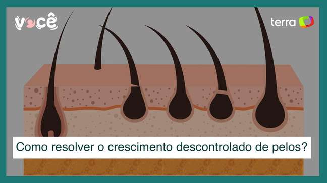 Disfunções hormonais causam crescimento descontrolado de pelos: como resolver